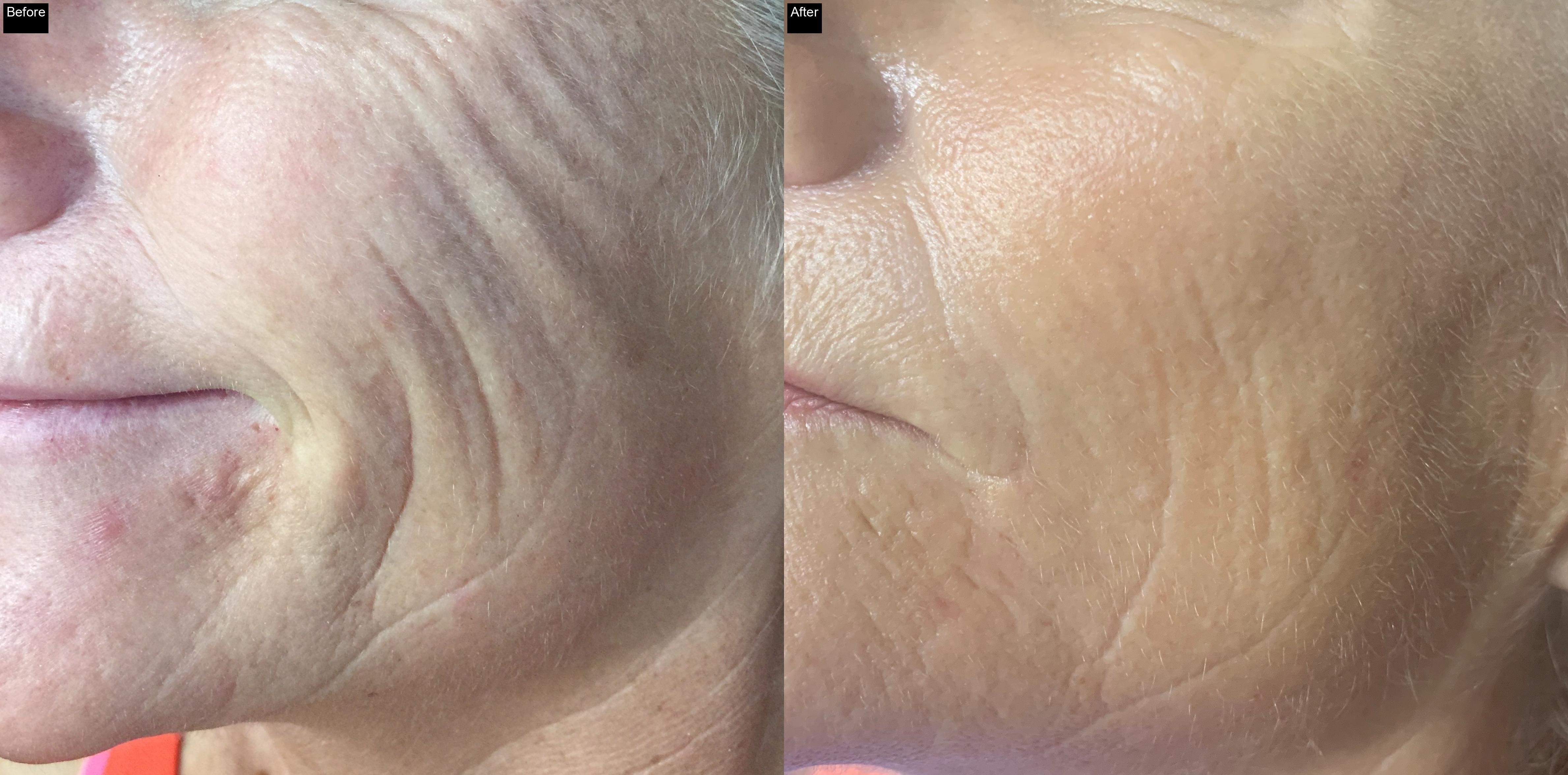 Before / After : Acne Scar Removal with IPL in Javea -3