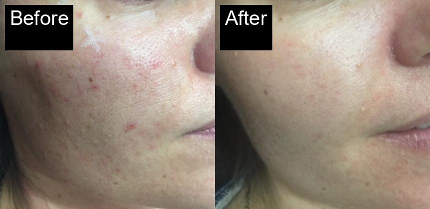 Before / After : Acne Scar Removal with IPL in Javea -4