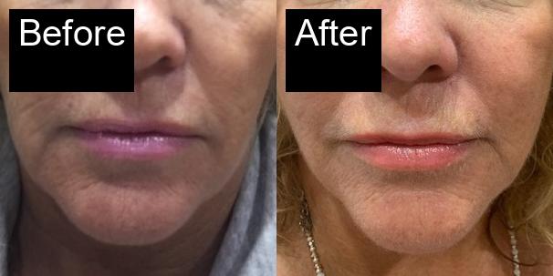 Before / After : Aptos Threadlift in Javea – Non-Surgical Skin Tightening -2