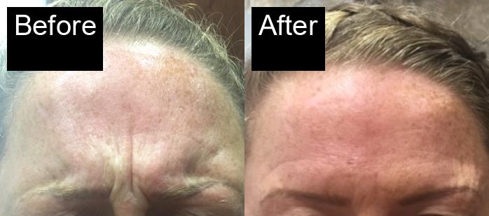 Before / After : Botox Treatments in Javea - Expert Anti-Aging Solutions -13