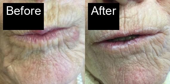 Before / After : Botox Treatments in Javea - Expert Anti-Aging Solutions -14