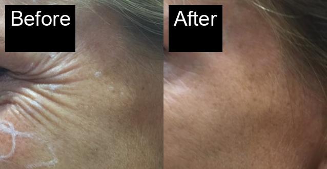 Before / After : Botox Treatments in Javea - Expert Anti-Aging Solutions -15