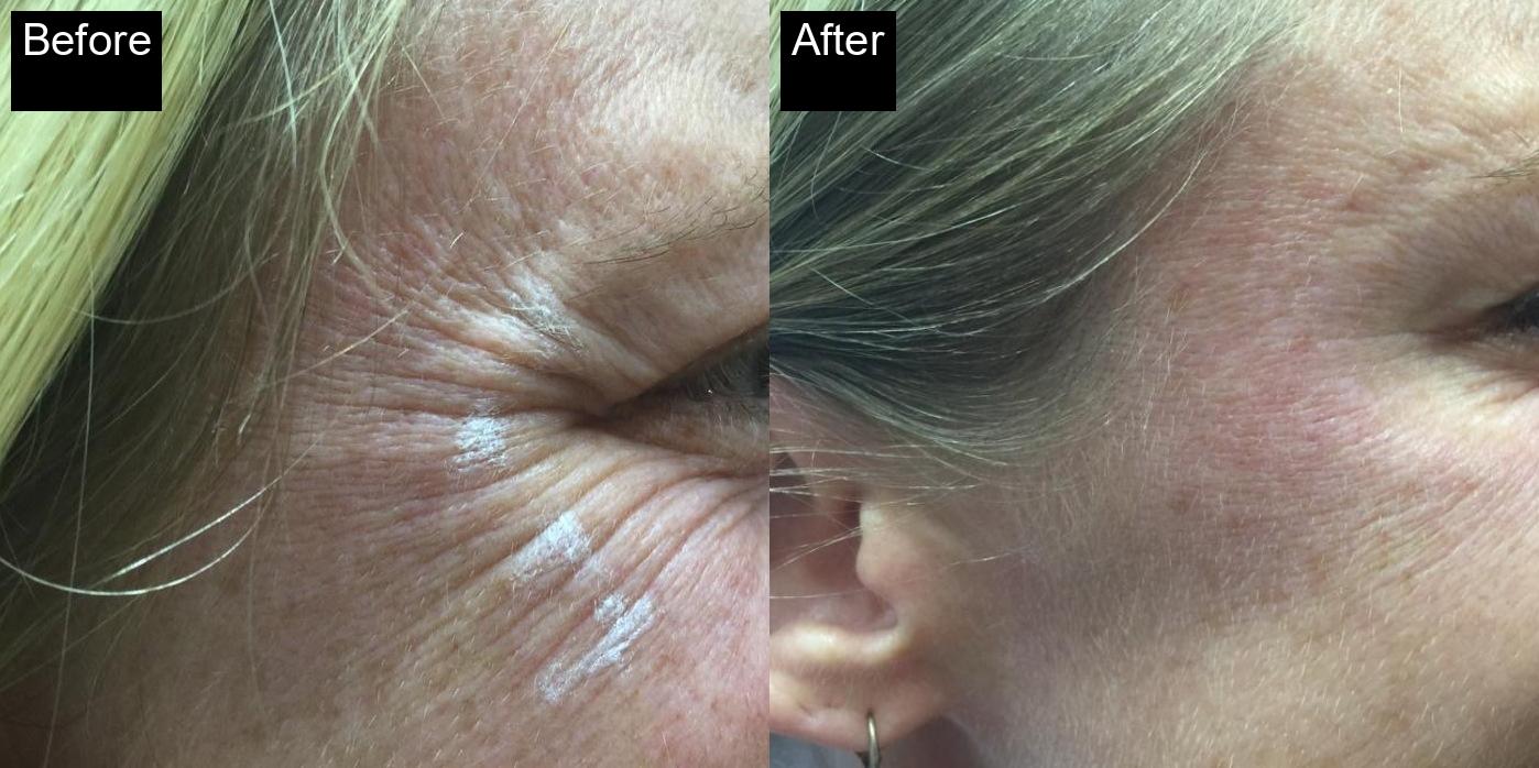 Before / After : Botox Treatments in Javea - Expert Anti-Aging Solutions -16