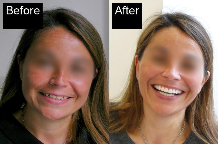 Before / After : Botox Treatments in Javea - Expert Anti-Aging Solutions -2