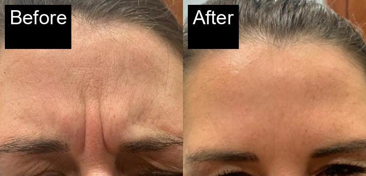 Before / After : Botox Treatments in Javea - Expert Anti-Aging Solutions -5