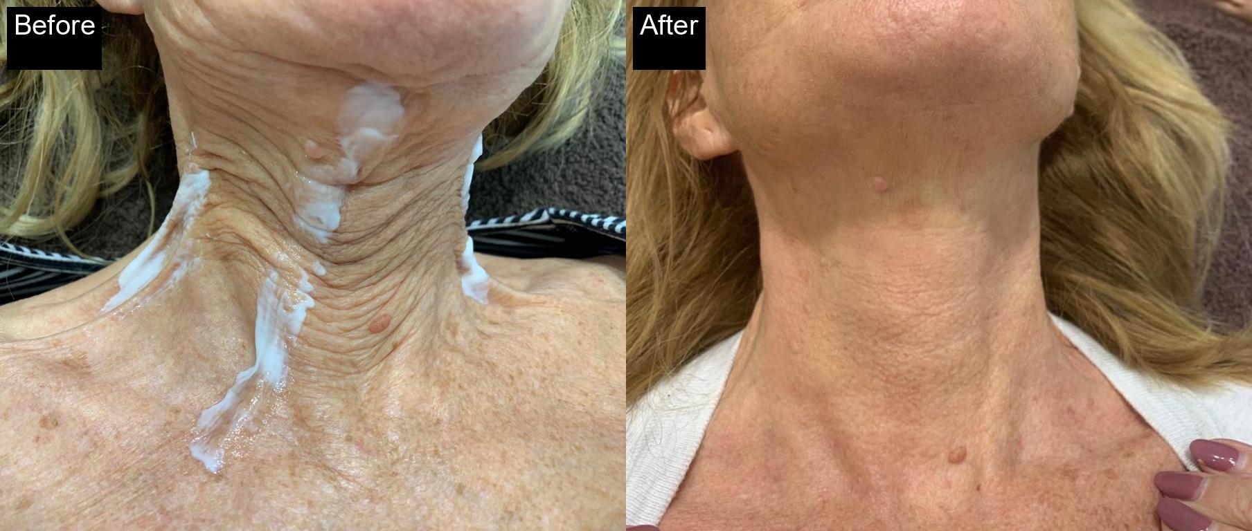 Before / After : Botox Treatments in Javea - Expert Anti-Aging Solutions -8
