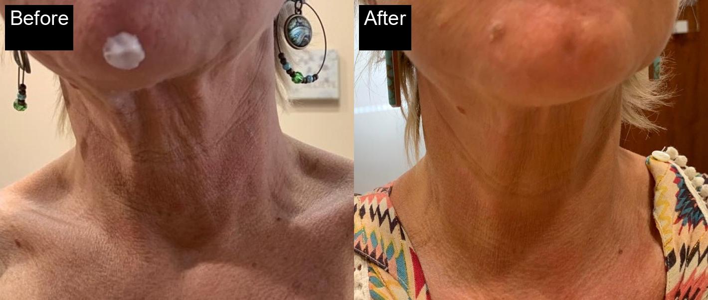 Before / After : Botox Treatments in Javea - Expert Anti-Aging Solutions -9