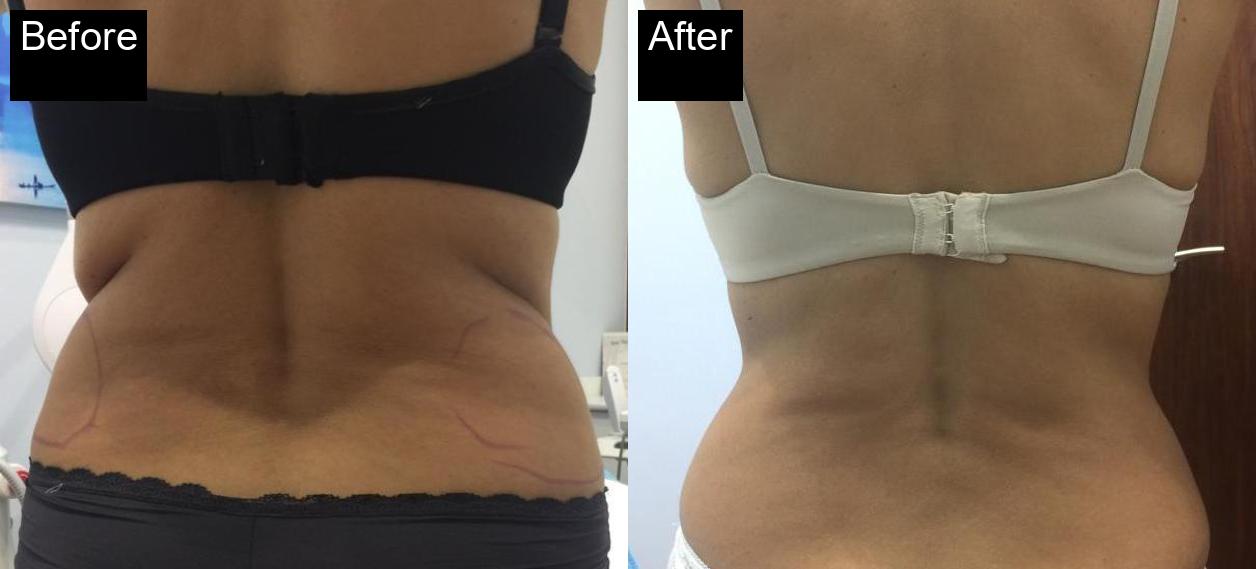 Before / After : Cryolipolysis in Javea With Spa Javea -2
