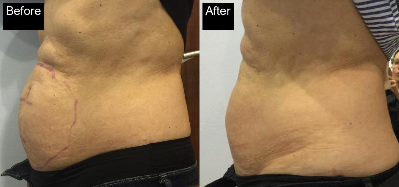 Before / After : Cryolipolysis in Javea With Spa Javea -3