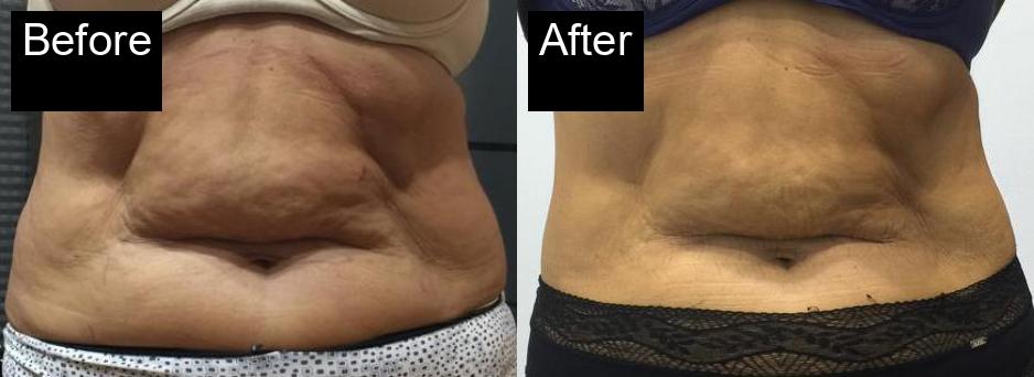 Before / After : Cryolipolysis in Javea With Spa Javea -4