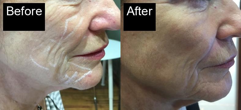 Before / After : Facial Rejuvenation in Javea – Achieve Youthful, Glowing Skin -2