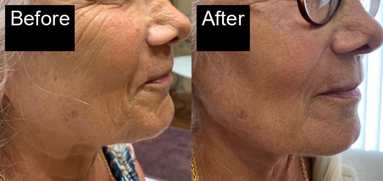 Before / After : Facial Rejuvenation in Javea – Achieve Youthful, Glowing Skin -3