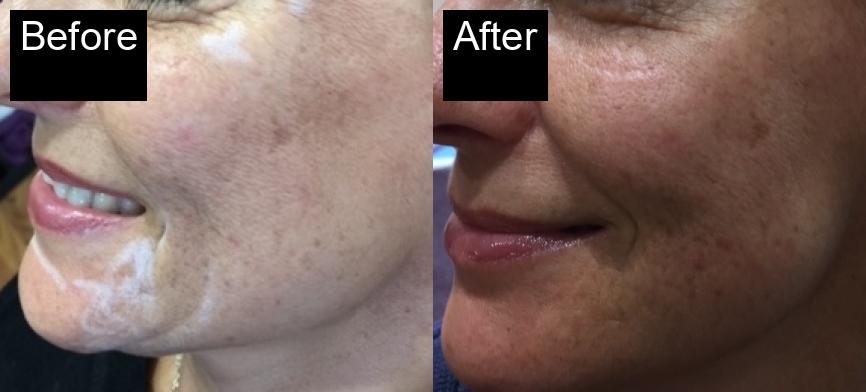 Before / After : Facial Rejuvenation in Javea – Achieve Youthful, Glowing Skin -5