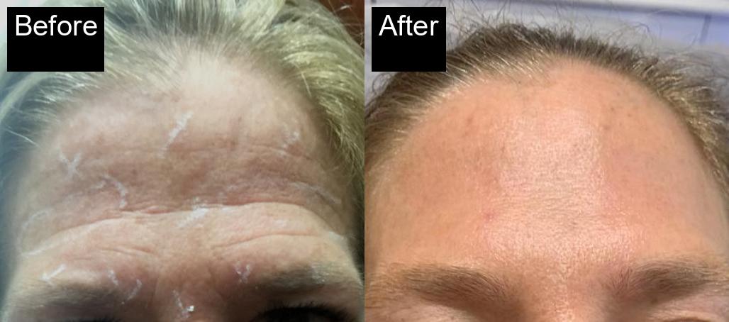 Before / After : Fillers Treatments in Javea – Restore Youthful Skin & Volume -1