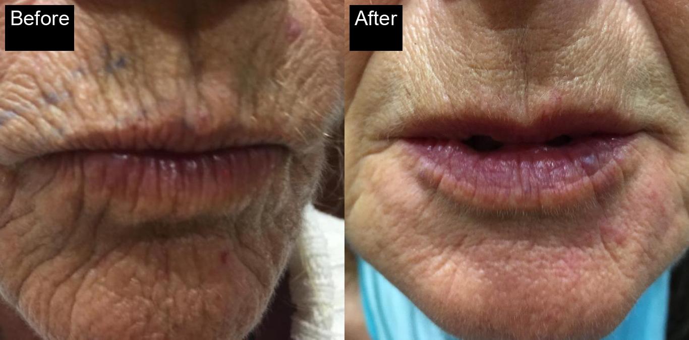 Before / After : Fillers Treatments in Javea – Restore Youthful Skin & Volume -12