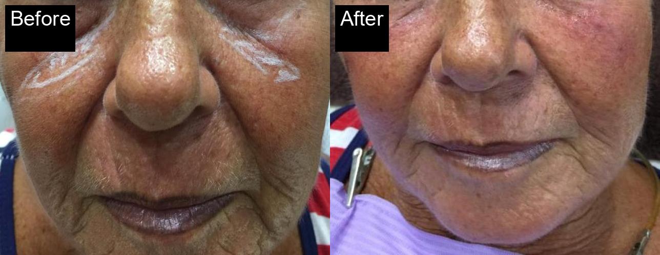 Before / After : Fillers Treatments in Javea – Restore Youthful Skin & Volume -13
