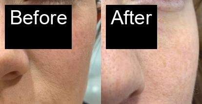 Before / After : Fillers Treatments in Javea – Restore Youthful Skin & Volume -14