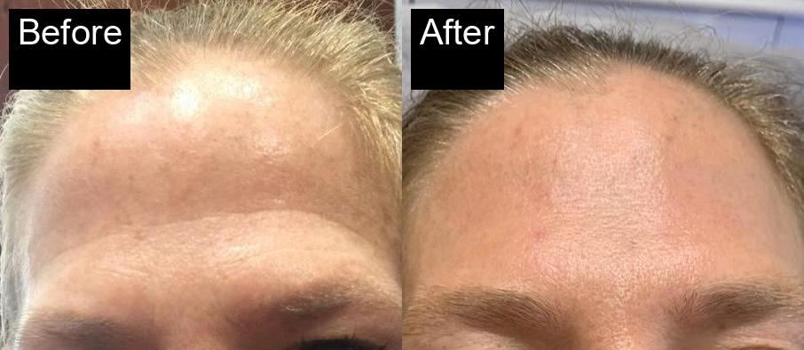 Before / After : Fillers Treatments in Javea – Restore Youthful Skin & Volume -3