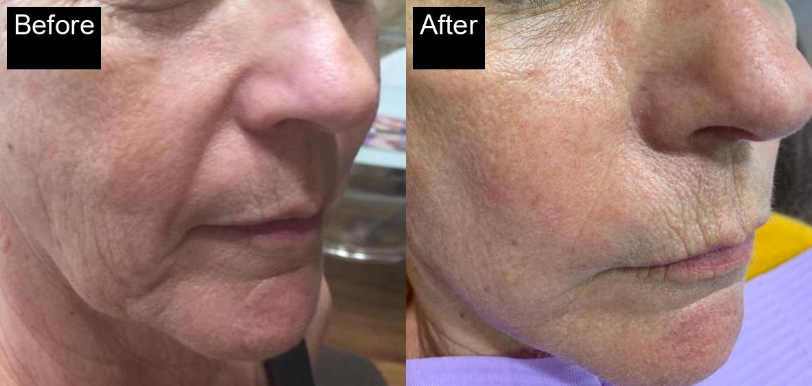 Before / After : Fillers Treatments in Javea – Restore Youthful Skin & Volume -5