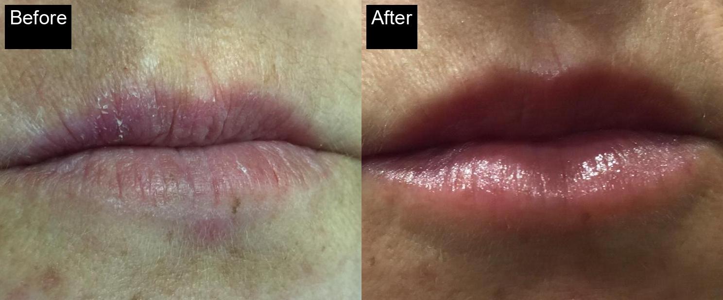 Before / After : Fillers Treatments in Javea – Restore Youthful Skin & Volume -7