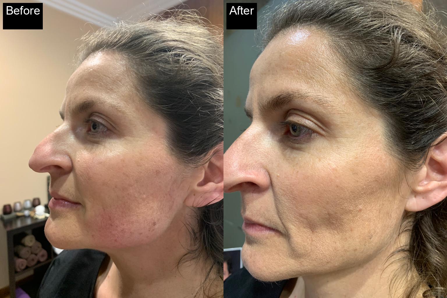 Before / After : HIFU Non-Surgical Facelift in Javea – Smooth and Tighten Your Skin -1