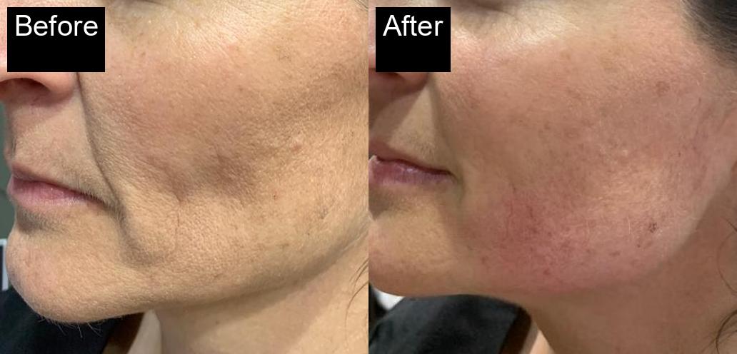 Before / After : HIFU Non-Surgical Facelift in Javea – Smooth and Tighten Your Skin -2