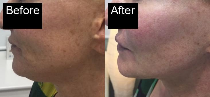 Before / After : HIFU Non-Surgical Facelift in Javea – Smooth and Tighten Your Skin -4