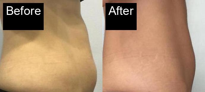 Before / After : HIFU Non-Surgical Facelift in Javea – Smooth and Tighten Your Skin -5