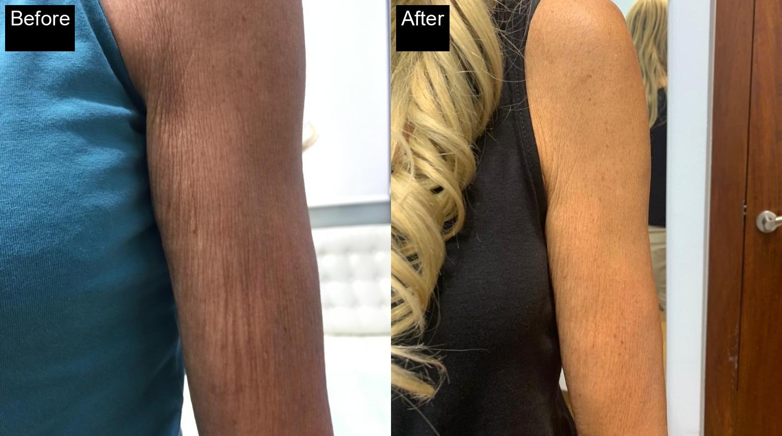 Before / After : HIFU Non-Surgical Facelift in Javea – Smooth and Tighten Your Skin -6