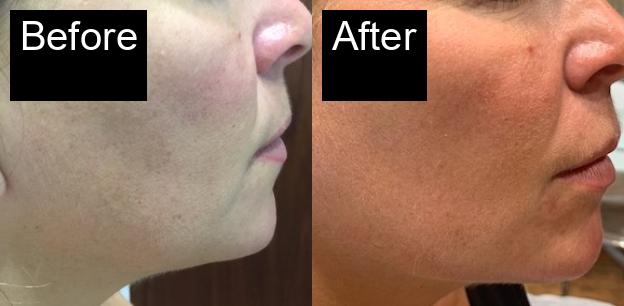 Before / After : HIFU Non-Surgical Facelift in Javea – Smooth and Tighten Your Skin -7