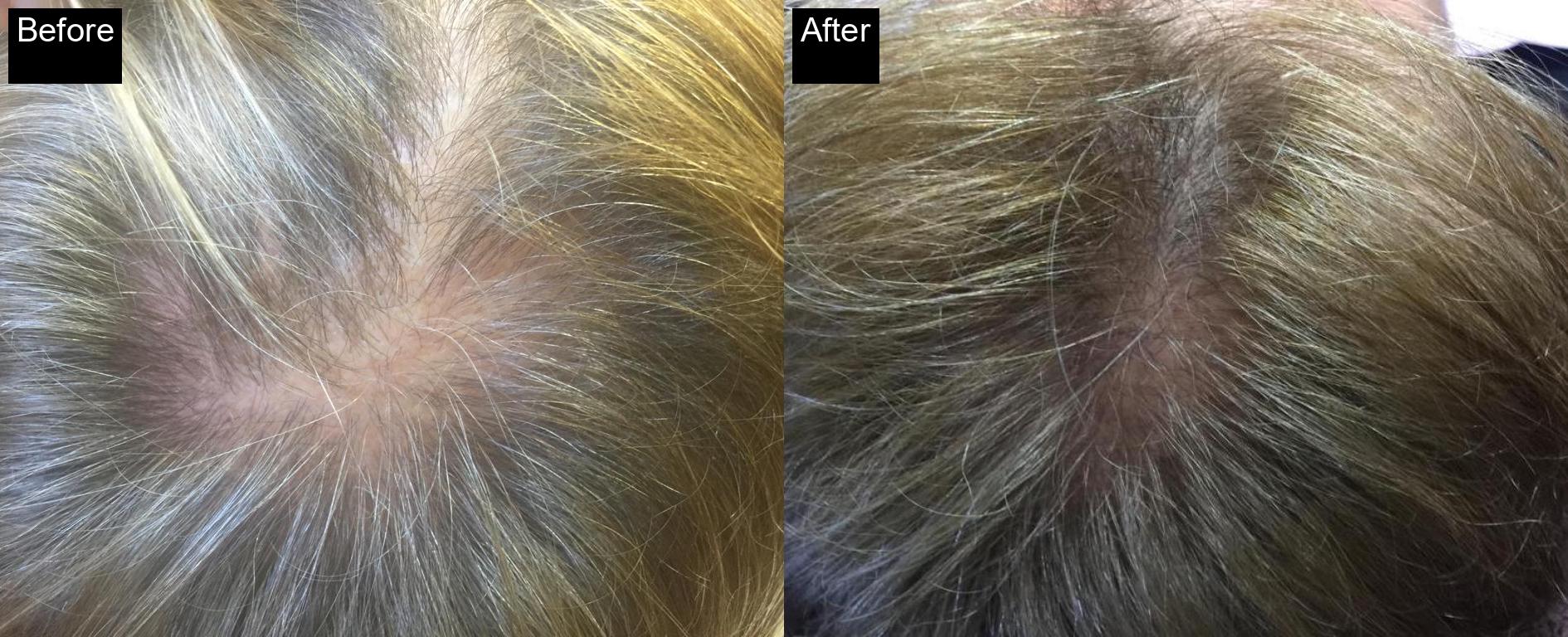 Before / After : Mesotherapy & Microneedling in Javea – Advanced Anti-Aging Treatments -3