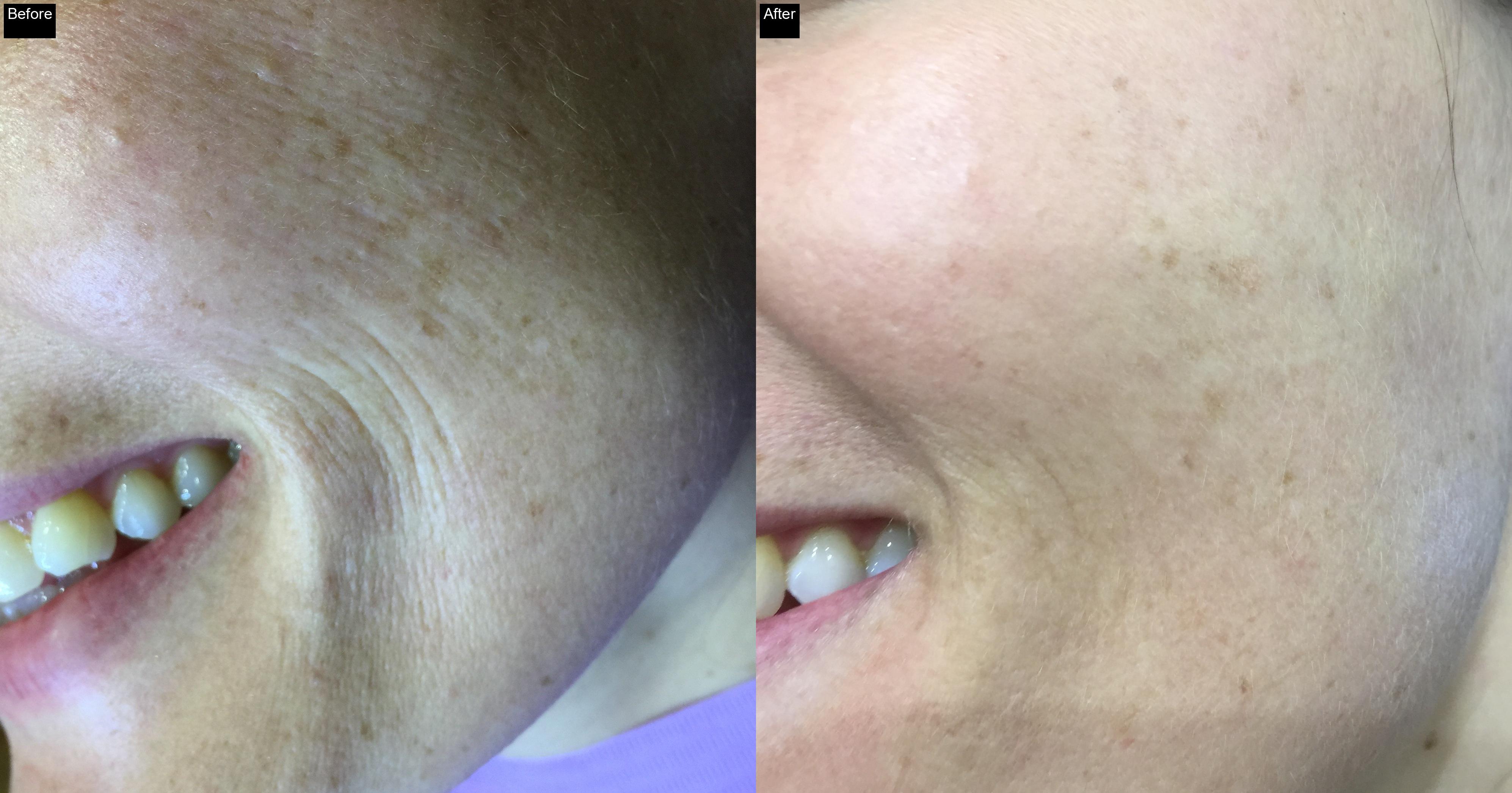 Before / After : Mesotherapy & Microneedling in Javea – Advanced Anti-Aging Treatments -6