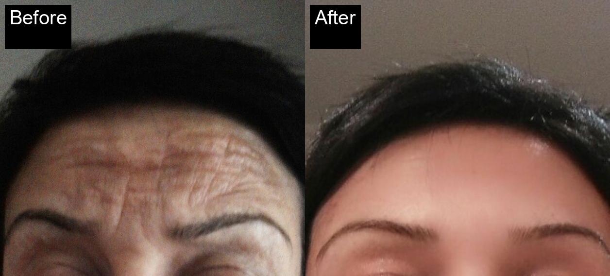 Before / After : Peels in Javea : Revitalize Your Skin with Chemical Peels in Javea -1