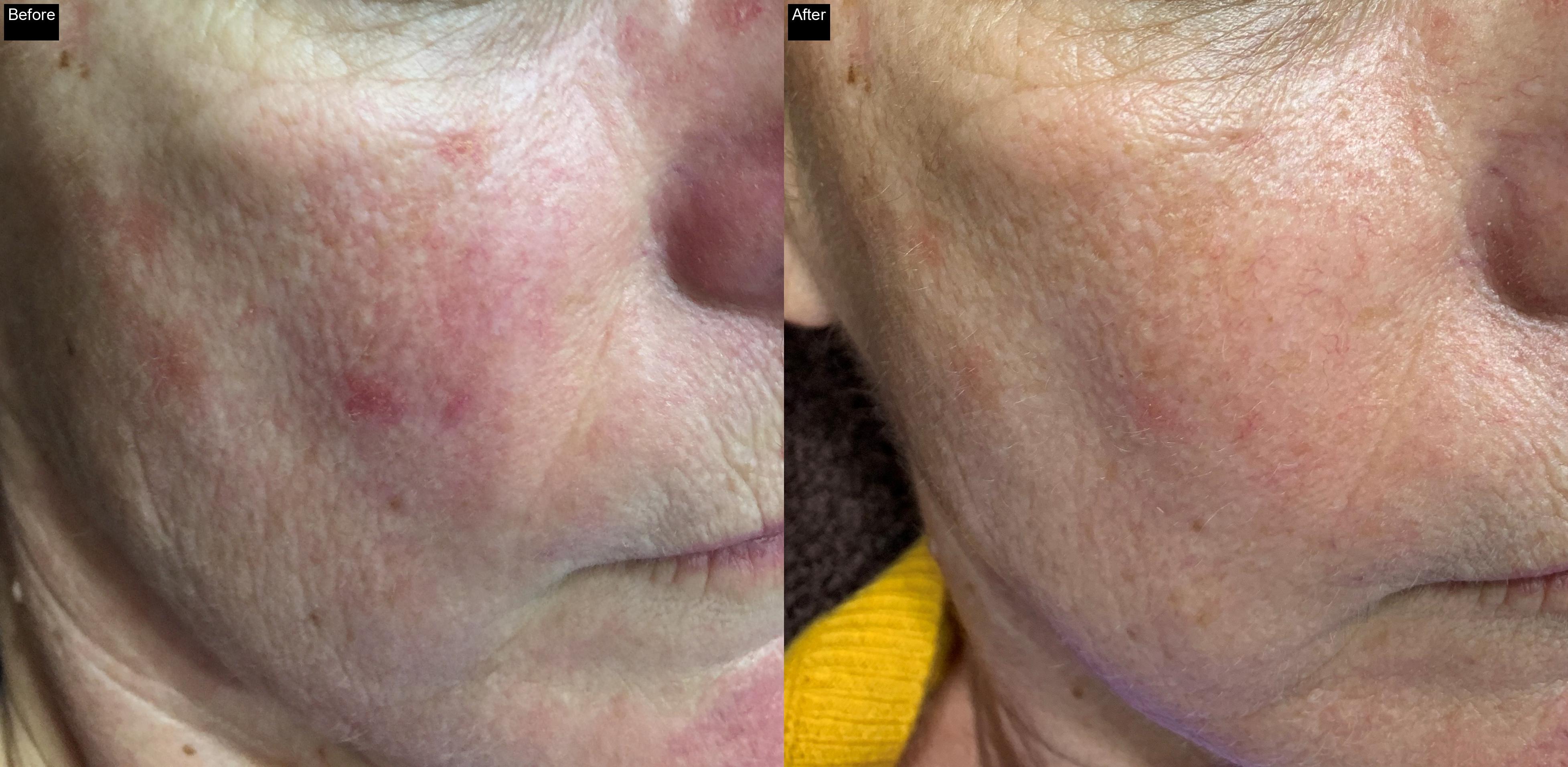Before / After : Peels in Javea : Revitalize Your Skin with Chemical Peels in Javea -2