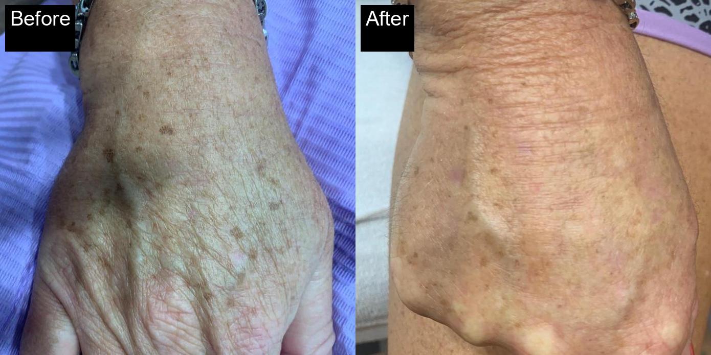 Before / After : Photorejuvenation Treatment in Javea -1