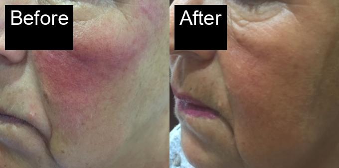 Before / After : Photorejuvenation Treatment in Javea -2