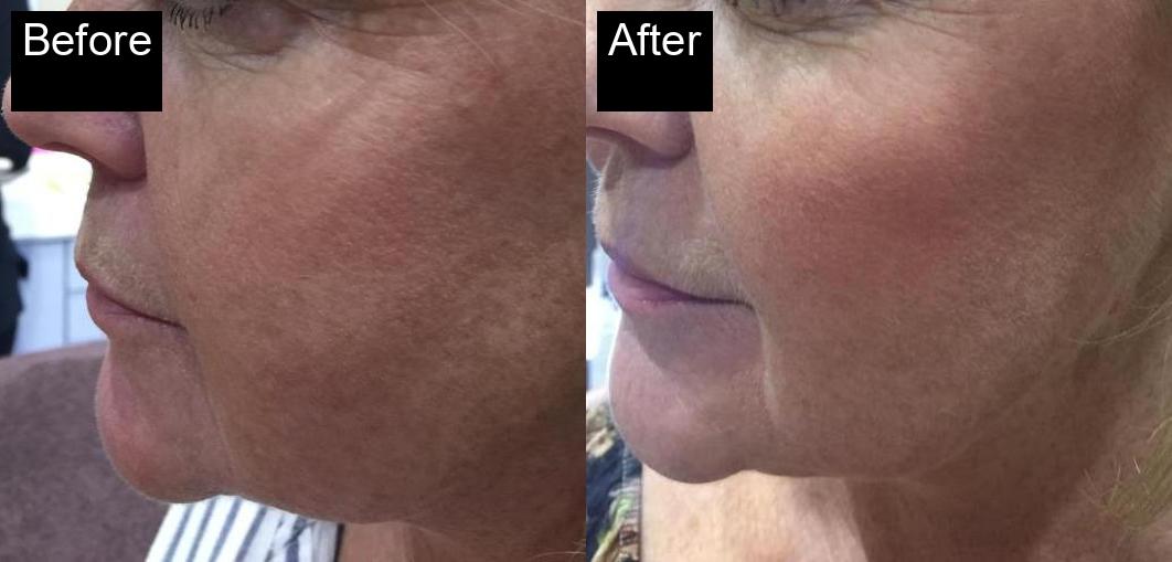 Before / After : Photorejuvenation Treatment in Javea -3